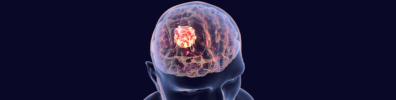 Brain tumour symptoms that should not be overlooked